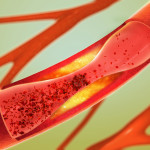 Further Insights in Lowering LDL Cholesterol: Managing Atherosclerotic Disease in High-Risk Patients