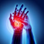 Applying Novel Approaches in Psoriatic Arthritis to More Effectively Treat Patients